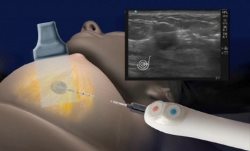 Новая технология криотерапии IceSense3